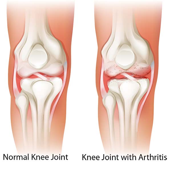 knee pain reno, knee arthritis reno, photo of knee arthritis illustration, swift urgent clinic in reno and sparks nevada